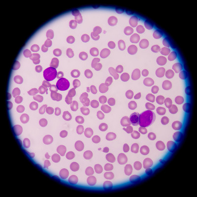 急性骨髓性白血病(AML)
