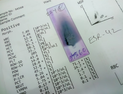 血液涂片染色玻片分离与血液科报告。款全新吉姆沙染色剂