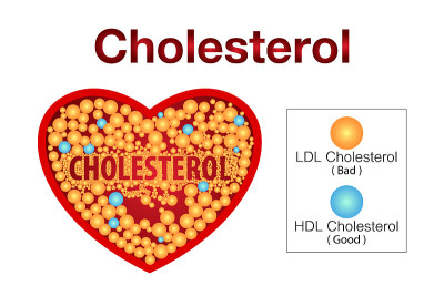 Cholesterol in artery, health risk , vector design