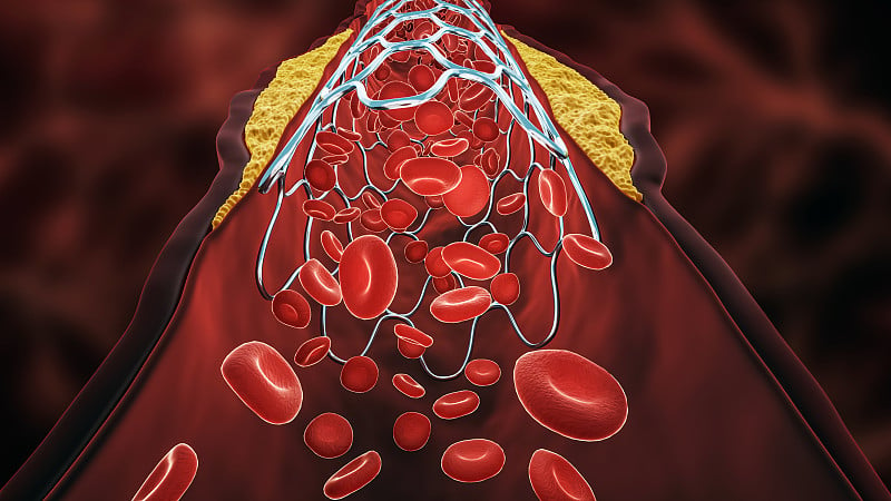 血管成形术三维渲染图。支架放置在病变动脉或血管中，血管被胆固醇或动脉粥样硬化斑块堵塞，伴随血流。外科