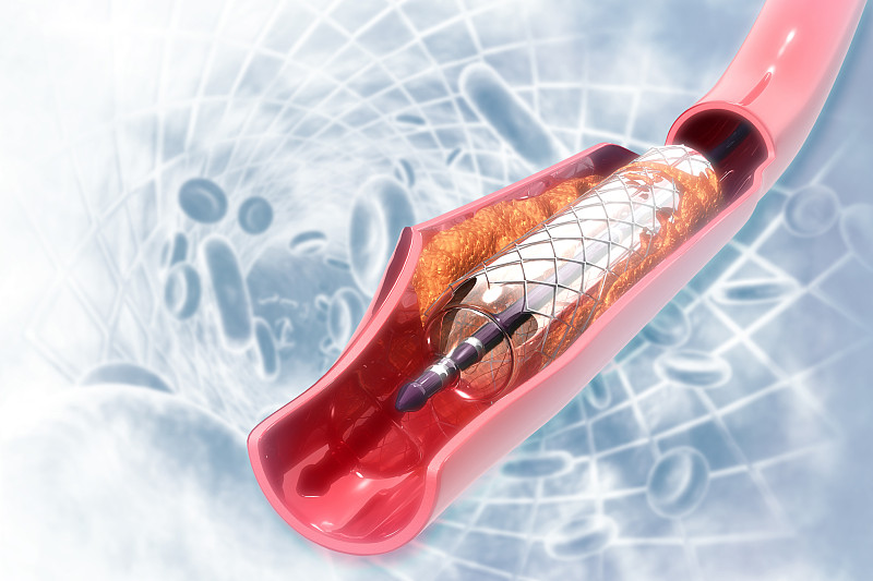 支架血管成形术的科学背景