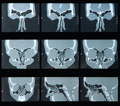 鼻窦MRI