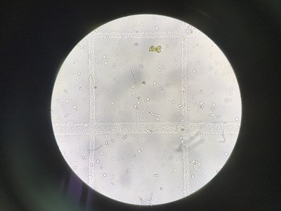 真菌感染在尿液中表现为芽殖酵母细胞和嗜菌丝。