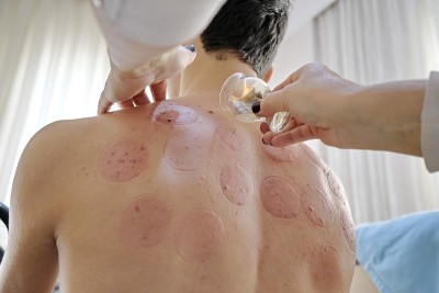传统的Hijama治疗和健康疗法