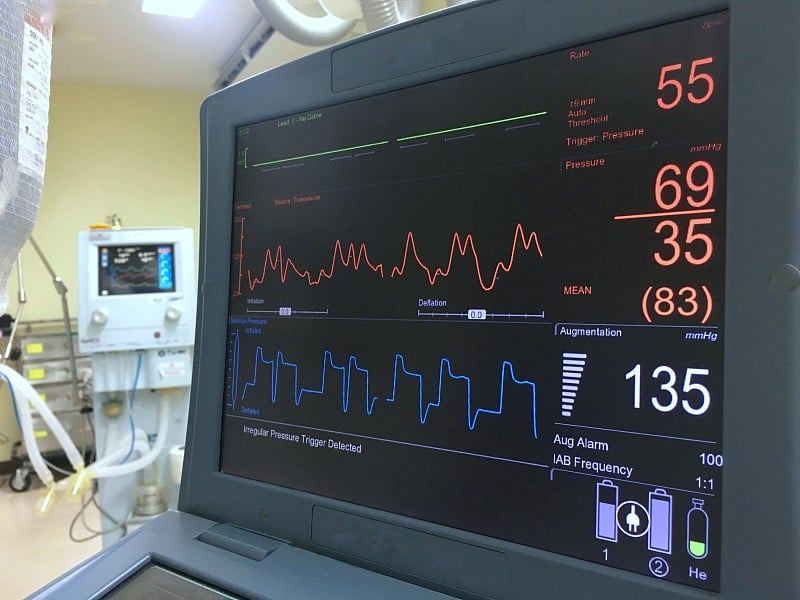 主动脉内气囊泵。医院医疗器械。