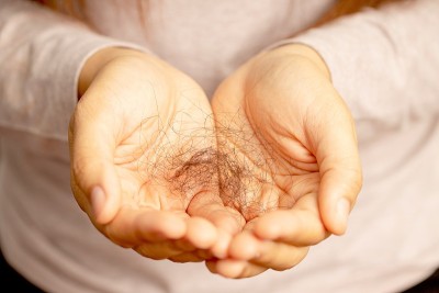 女性对洗发水过敏会导致脱发和头皮屑。