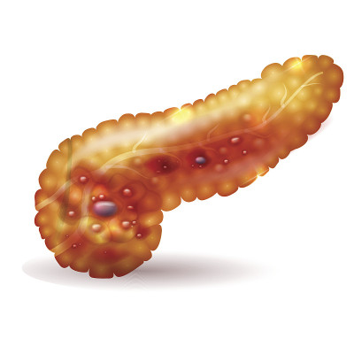 胰腺炎插图