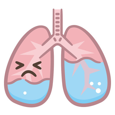 肺水肿肺疾病图有支气管和肺泡中液体漏在白色背景分离的载体插图。人体胸部解剖方案。