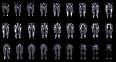 人体髋关节磁共振成像(MRI)