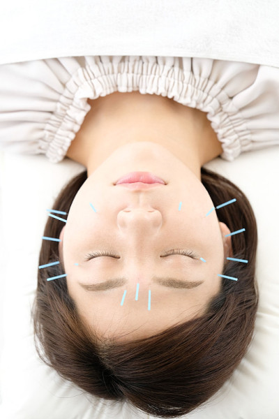 一个女人在针灸诊所接受脸部针灸