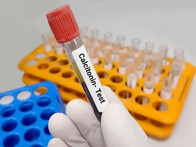 生物化学家或医生保存血液样本进行降钙素激素测试。它的作用是减少血钙，与甲状旁腺激素(PTH)的作用相