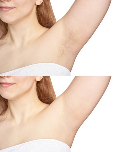 Girl underarm. White woman armpit. Before and afte