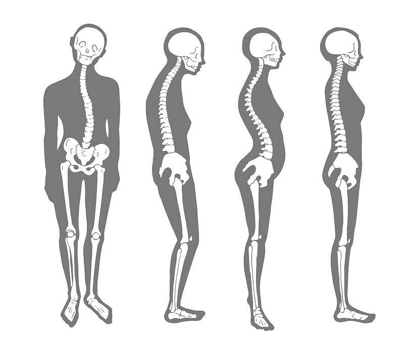 Female correct and bad skeleton