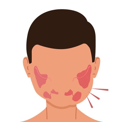 唾液腺发炎的人。医疗矢量插图。