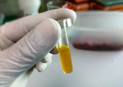 科学家持有高胆红素血清样本，用于诊断黄疸病。