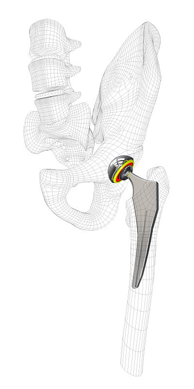 髋关节置换术的3d插图，孤立的灰色