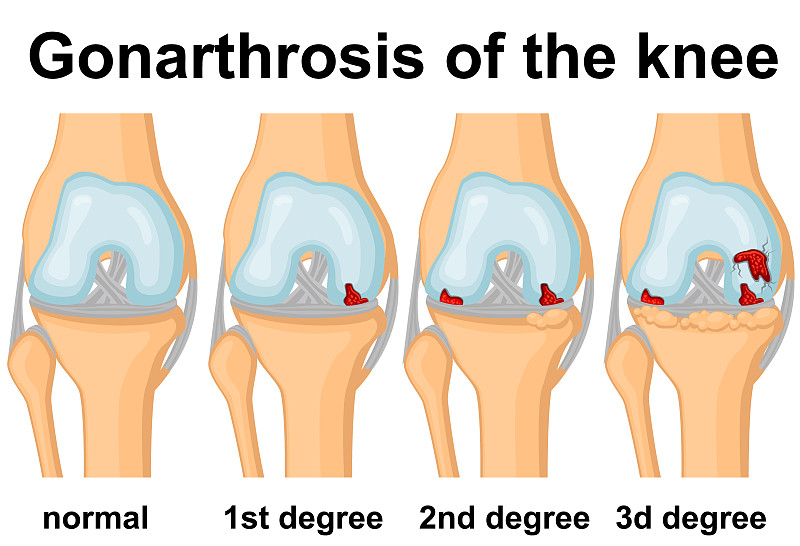 Gonarthrosis of the knee