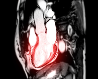 心脏MRI或心脏MRI(磁共振成像)对心脏左室容积的诊断心脏病。