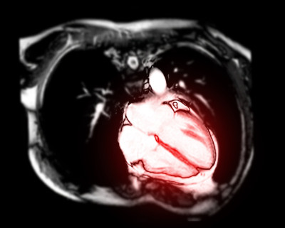 MRI心脏或心脏MRI(磁共振成像)心脏纵轴面显示4个腔室。
