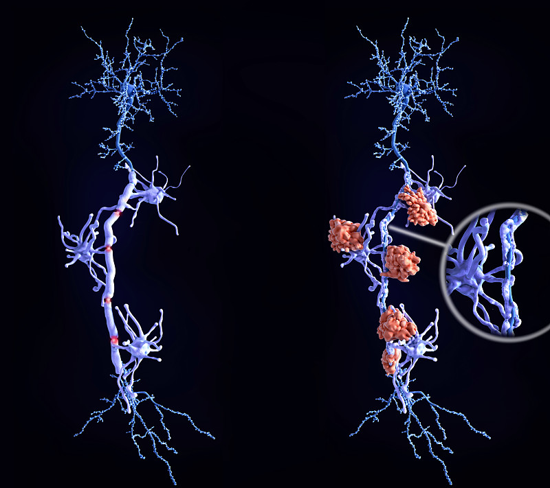 多发性硬化症(MS):髓鞘完整的健康神经元，受MS影响的神经元(右)