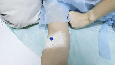 手臂俯视图，肘部静脉置入导管。