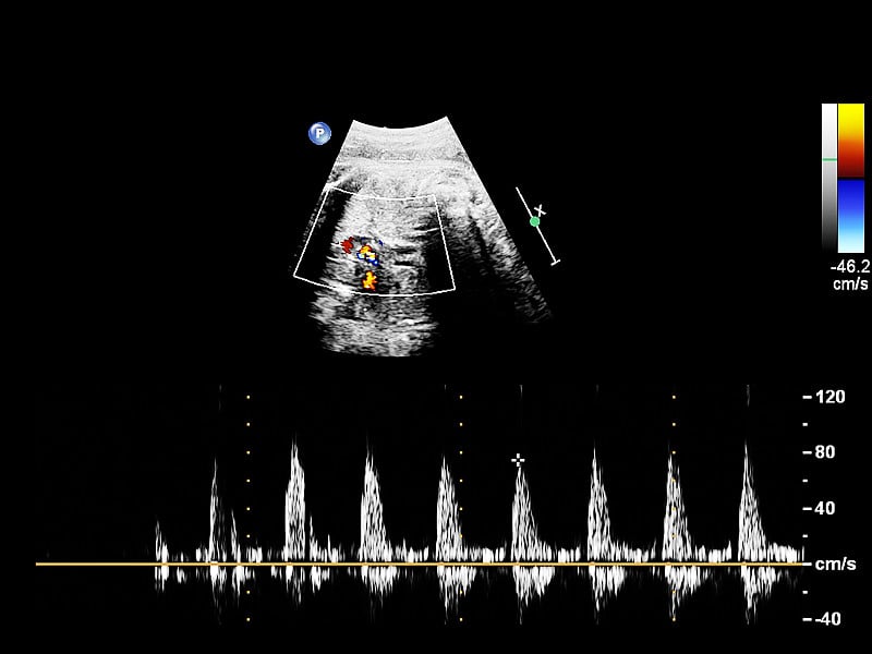 超声筛查胎儿超声心动图。