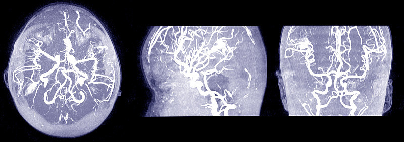 大脑Mri, mra和MRV。