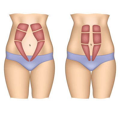 Abdominal muscles on a woman belly