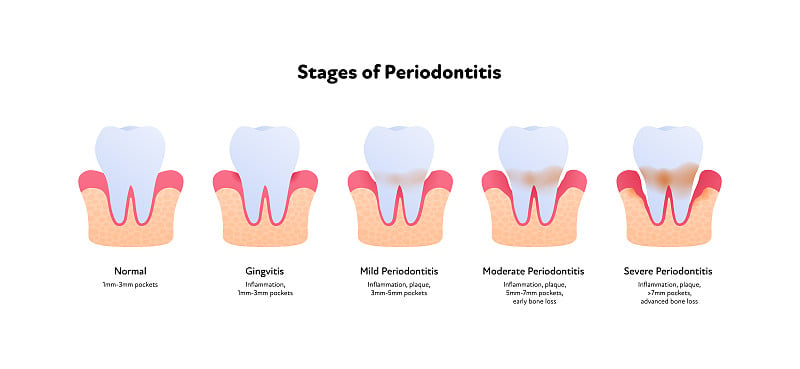 牙齿解剖及龋坏图。向量生物医学插图。侧视图。在白色背景上分离的牙周炎疾病的分期。为医疗保健、牙科设计