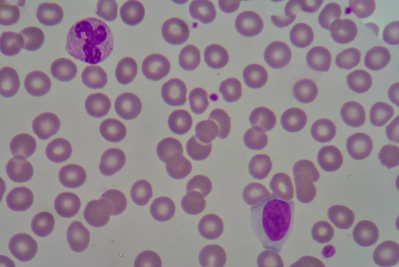 neutrophil&lymphocyte