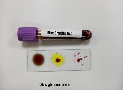 玻片凝集法验血，B型阳性。医学的概念