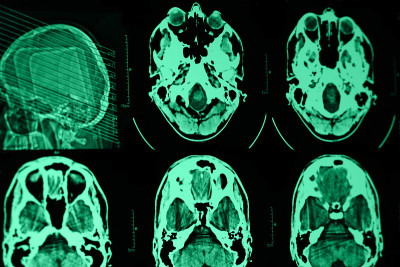 头颅CT和MRI