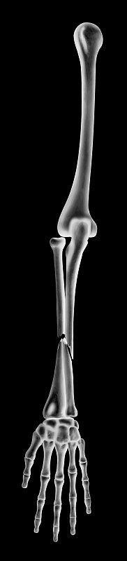 尺骨和桡骨骨折或断臂完全移位骨折的x线片类型-前视图- 3d医学-生物医学图解-医疗保健-黑色背景孤