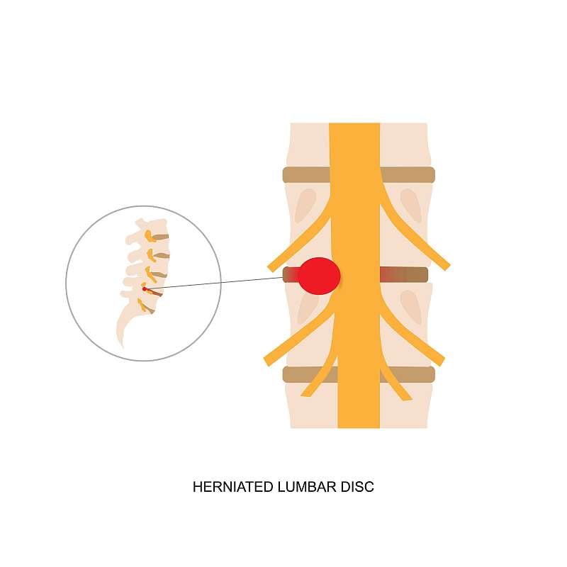 人体腰椎间盘突出的图示。