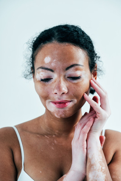 美丽的女人与白癜风皮肤在工作室摆姿势。身体积极和自我接纳的概念