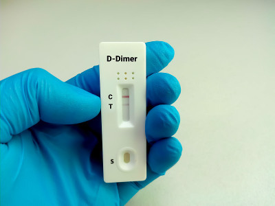 科学家或技术人员近距离观察，手握d -二聚体快速筛选试验装置。Covid-19患者监测测试。凝固。血