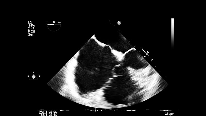 经食管超声检查心脏图像。