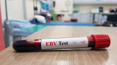 eb病毒(EBV)检测阳性及实验室血液检测样本用于诊断引起传染性单核细胞增多症的EBV感染。热带感染