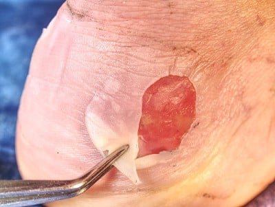从跟腱附着处去除烧伤皮肤。