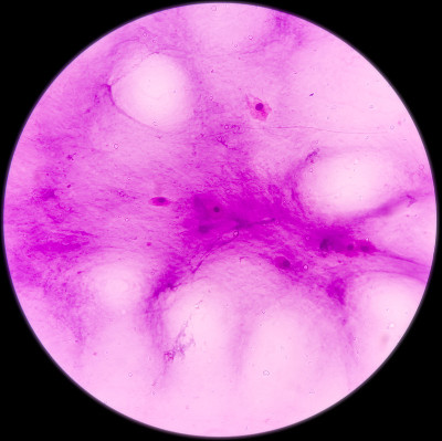 腕关节(FNA):神经节细胞，镜下可见泡沫组织细胞、淋巴细胞及背景蛋白
