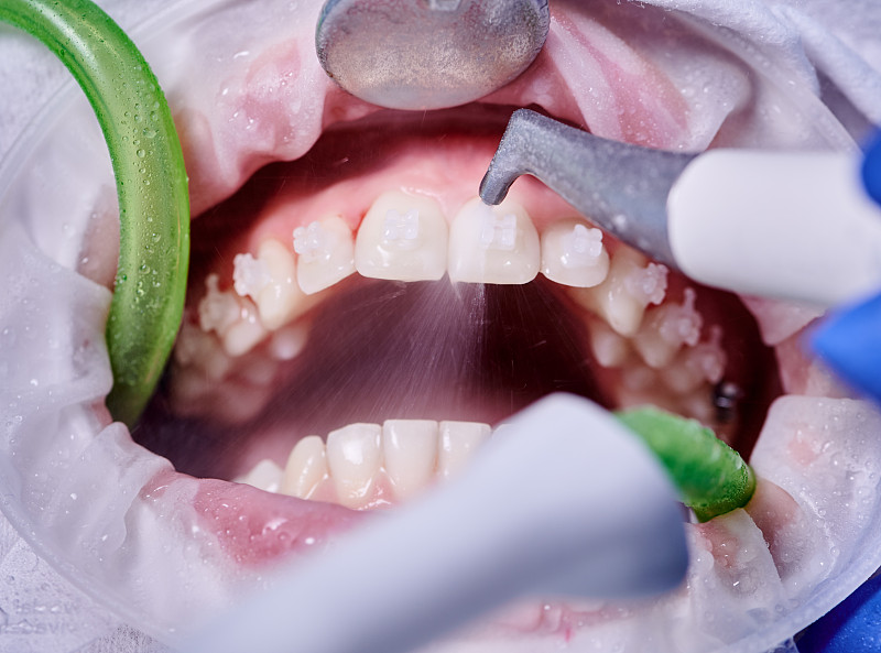 Doctor doing professional teeth cleaning in dental