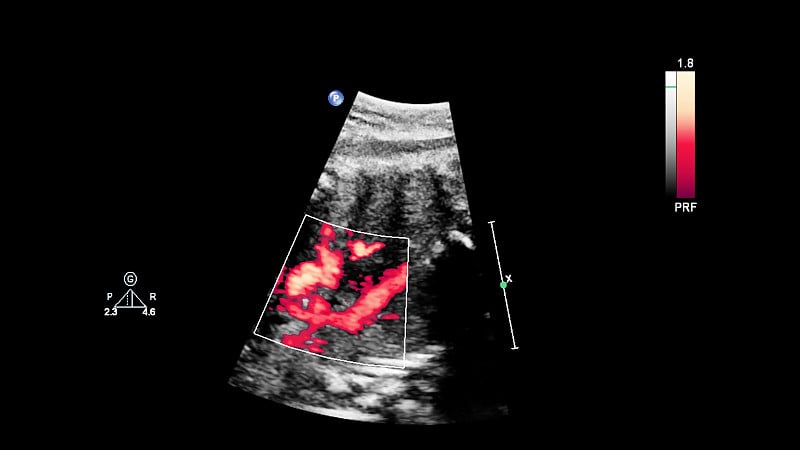 超声筛查胎儿超声心动图。