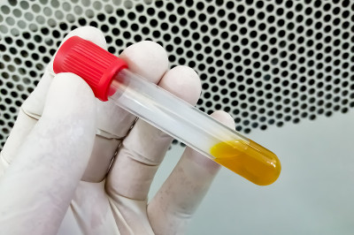 试管高胆红素血清样本用于诊断黄疸病。