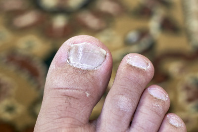 不健康的腿指状况