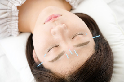 Up of a woman getting acupuncture on her face at a
