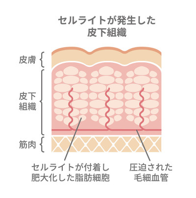 脂肪团皮肤插图(日语)