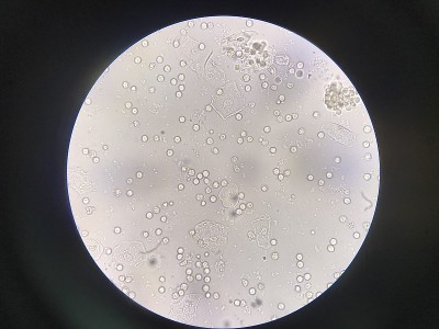尿中有中度白细胞和细菌细胞。