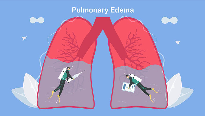 肺水肿是肺部充满液体的症状。治疗和诊断。身体努力获得足够的氧气，直到呼吸急促。