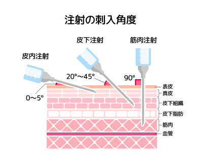 角度插入注入矢量插图