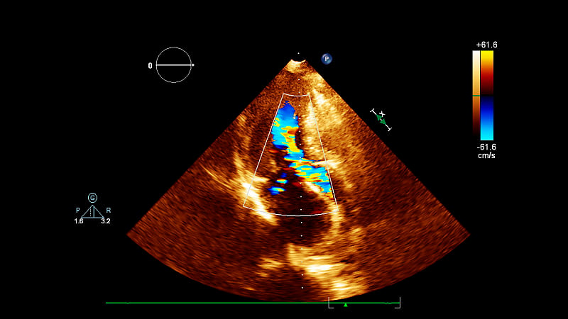 经食管超声检查心脏图像。